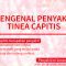 Mengenal Penyakit Tinea Capitis