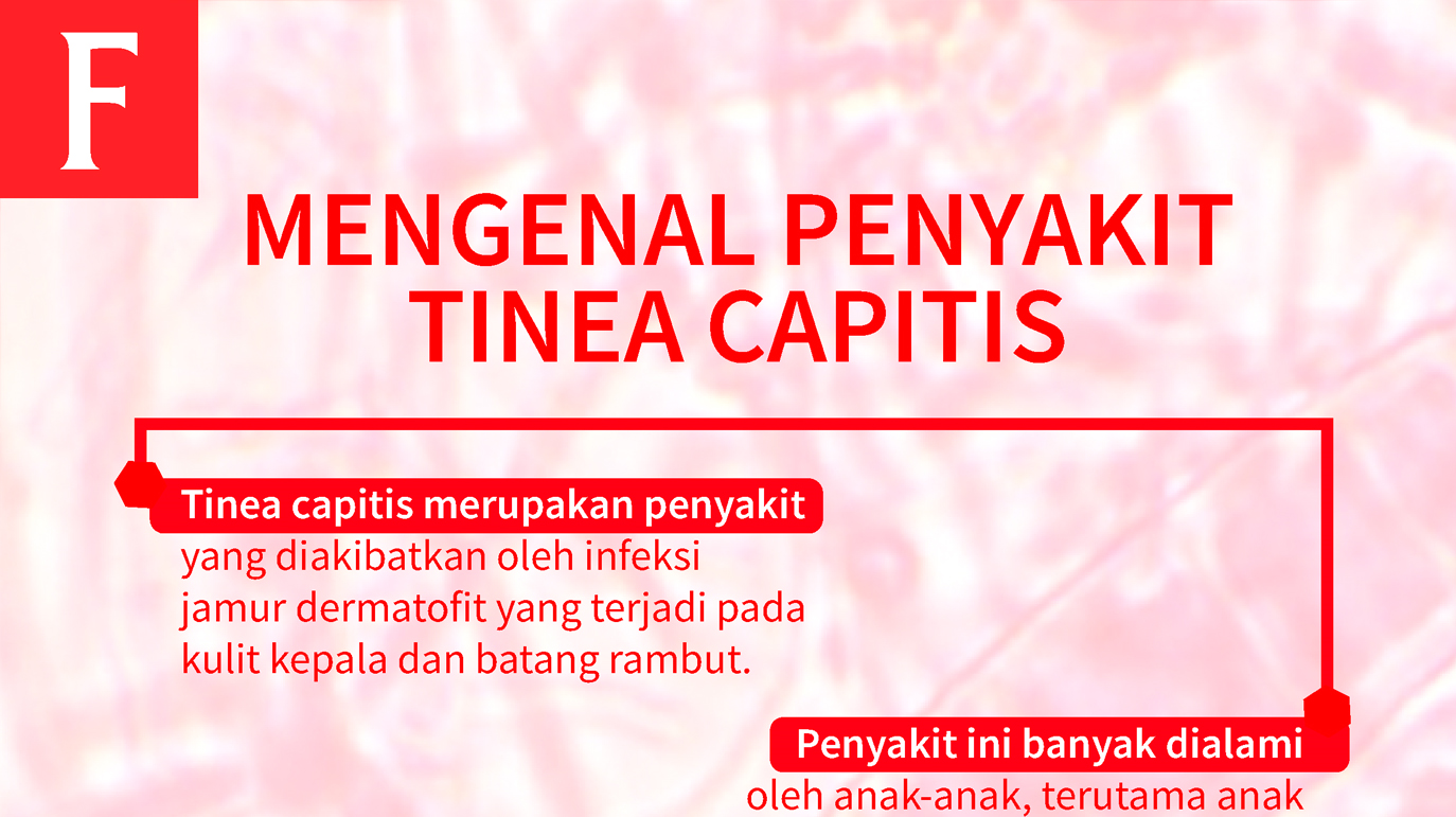Mengenal Penyakit Tinea Capitis